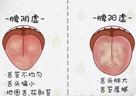 脾阴不足的孩子往往舌苔不均匀,地图舌,花剥苔,而且舌苔很薄,舌头很