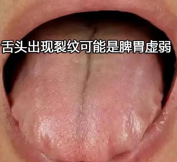 舌头出现裂纹可能是脾胃虚弱