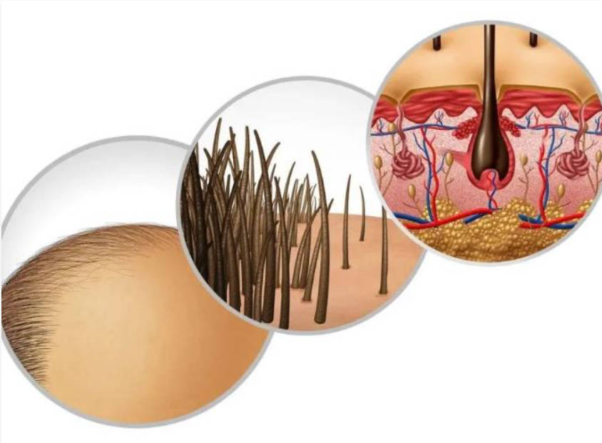 男性脱发，是毛囊不断在退化.jpg